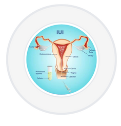 IUI Treatment